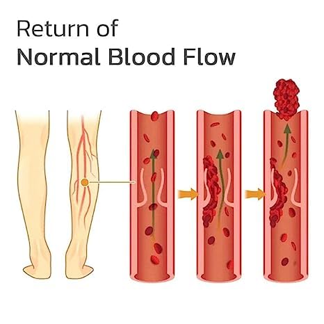 Veins Patches Dredge Vein Smoothing Varicose Veins Reduce Swelling Relieve Pain Instant Relief From Muscular Pain Improve Blood Circulation Skin Friendly (12pcs)