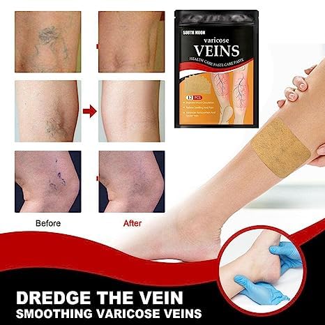 Veins Patches Dredge Vein Smoothing Varicose Veins Reduce Swelling Relieve Pain Instant Relief From Muscular Pain Improve Blood Circulation Skin Friendly (12pcs)